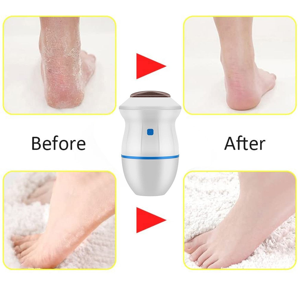 Pro Electric Foot Exfoliator – Dual-Speed Callus Remover & Vacuum Suction Foot Grinder